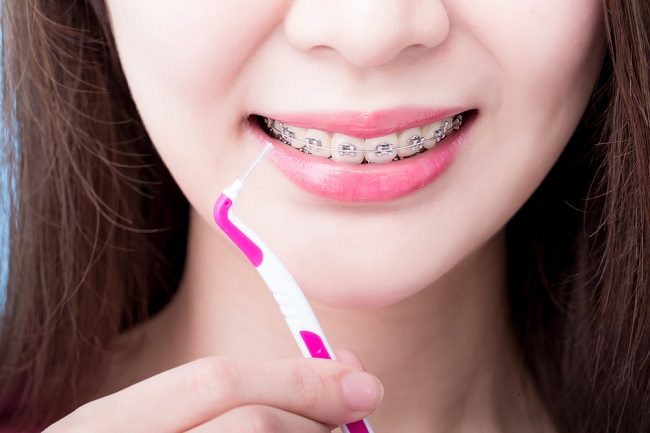 교정기 착용자의 치아 관리 방법