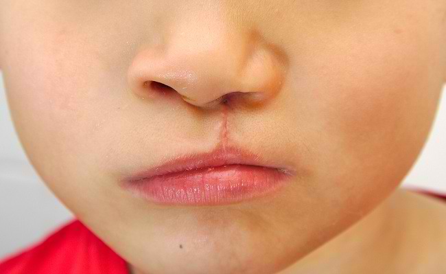 Cunoașteți cauzele buzelor despicate și tratamentul lor