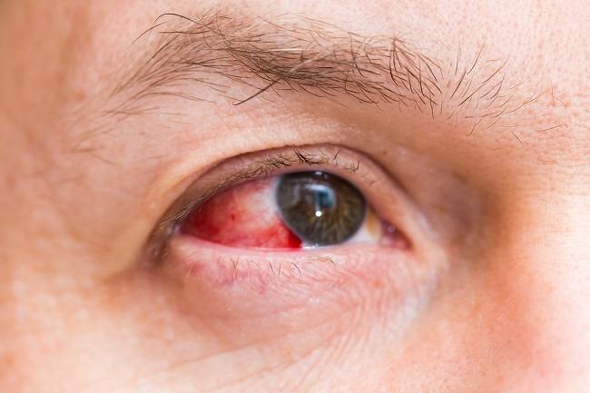 Rode vlekken in de ogen als gevolg van subconjunctivale bloedingen, deze oorzaken en genezing