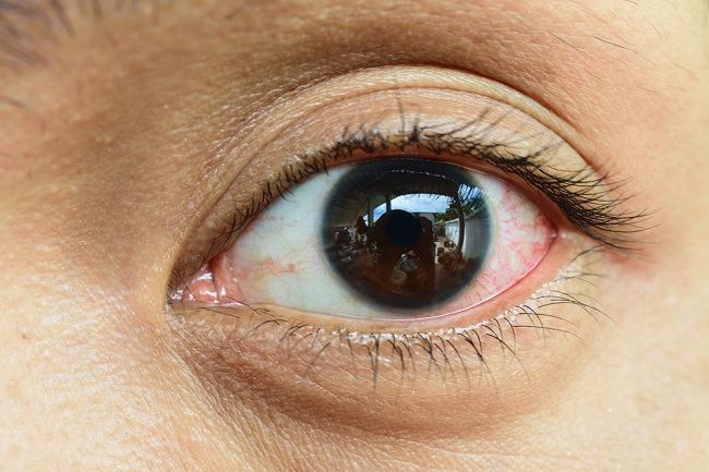 감염성 눈 통증의 유형, 치료 및 예방에 대해 알아보십시오.