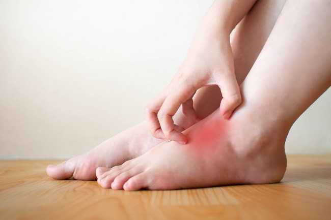 알아야 할 발의 피부 질환 5가지