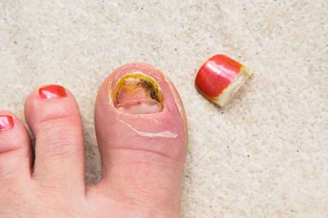 노란 손톱 증후군의 원인과 치료